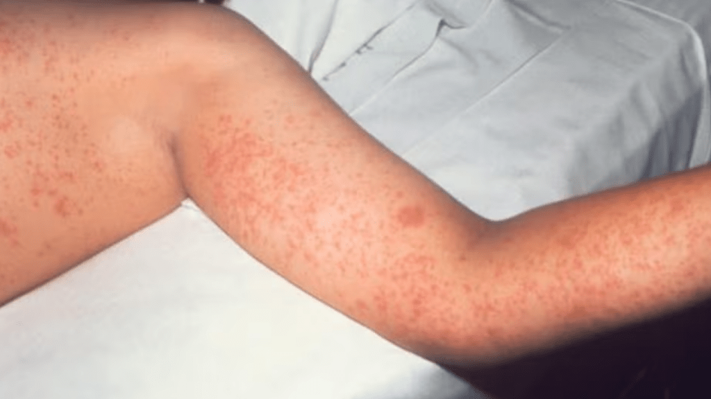 New measles cases in the Interior