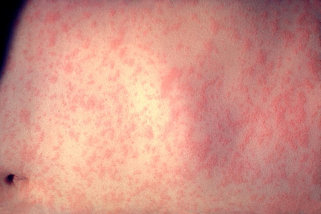 Measles exposure alert issued for BC Ferries sailings to Vancouver Island